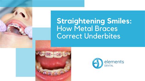 underbite metal bracket|braces for underbite.